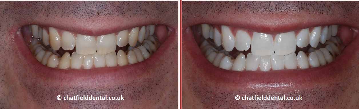 Zoom Whitening Gallery 1
