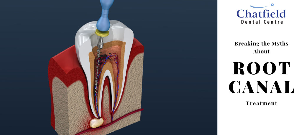 Breaking the Myths About Root Canal Treatment